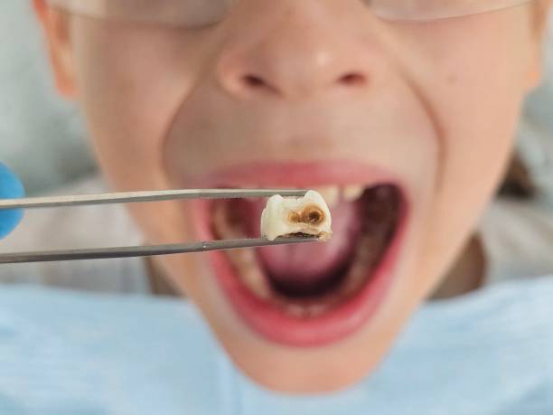 Best Emergency Dental Extractions in Yoe, PA
